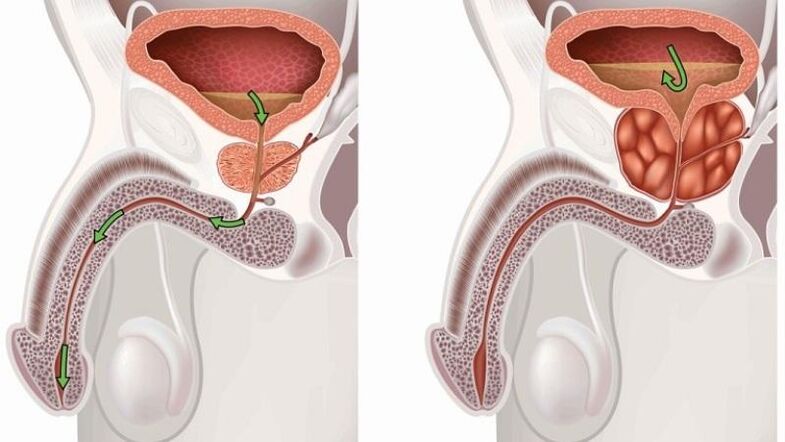 ristagno di urina sulla prostatite