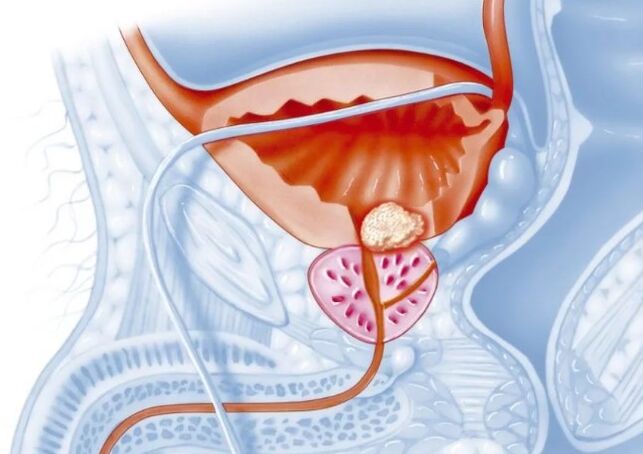 Caratteristiche della prostatite cronica